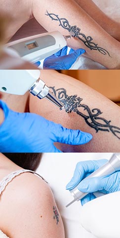 tatuajes eliminacion